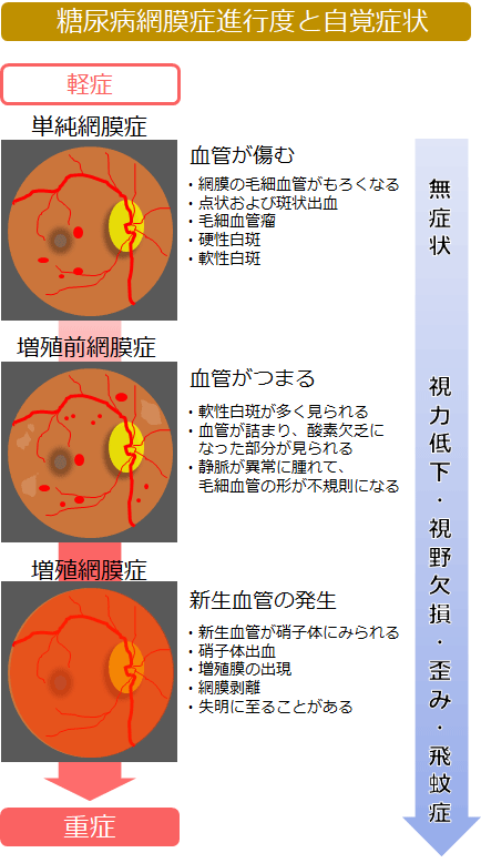 糖尿病網膜症進行度と自覚症状　図解